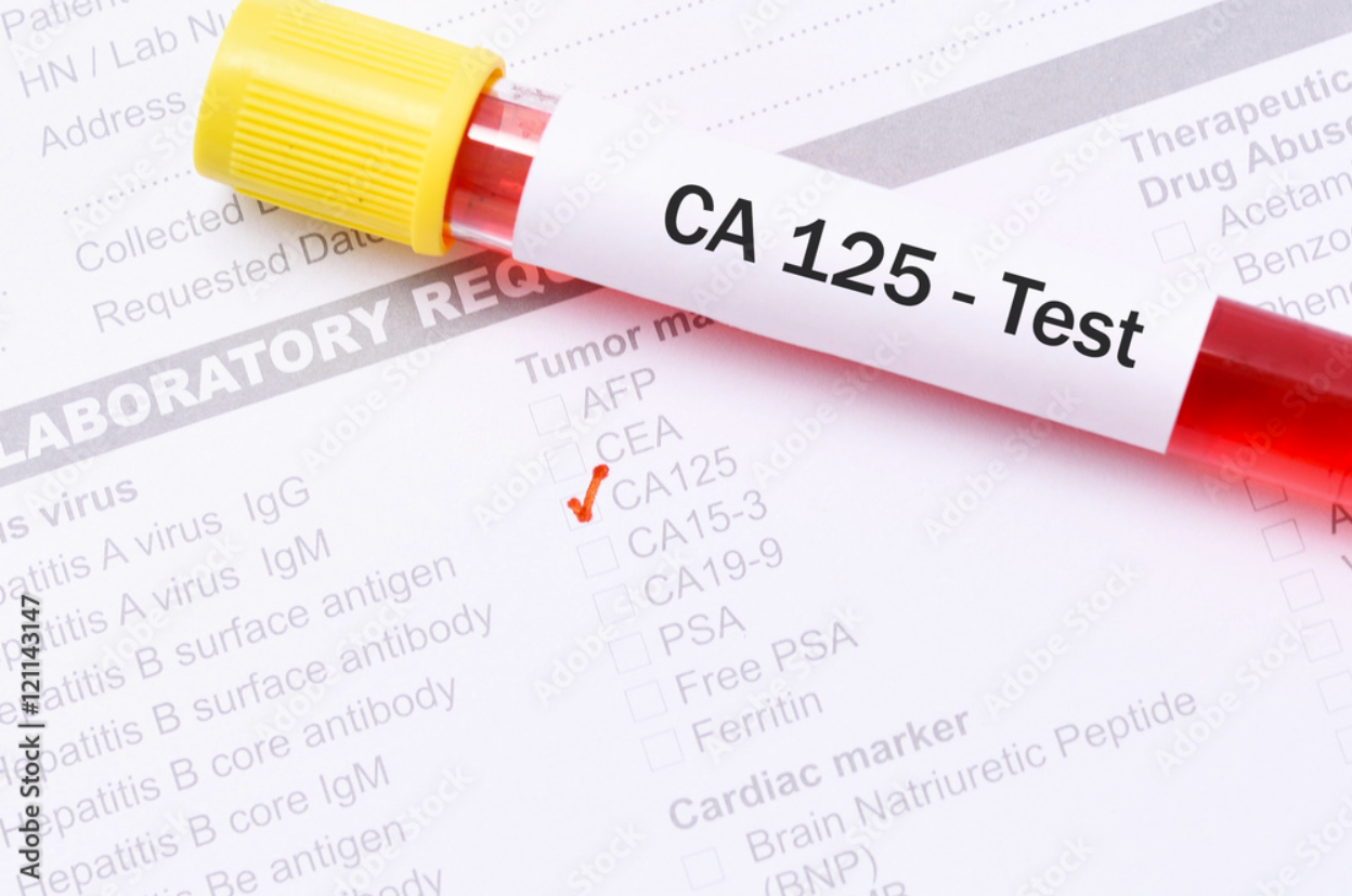 Xét nghiệm máu CA-125 (Ung thư buồng trứng)